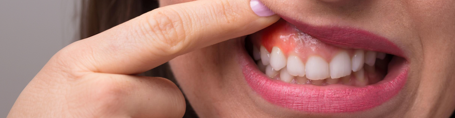 Close up of woman lifting top lip to show inflamed gums.
